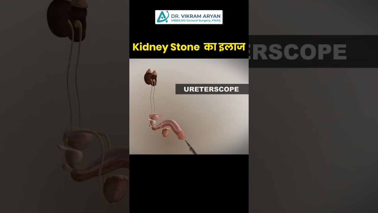 Laser Treatment For Kidney Stones #rirs #kidneystone