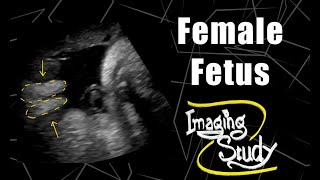 Female Fetus - Its a Girl || Ultrasound || Case 59