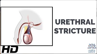 Urethral Stricture: A Painful Reality for Many Men