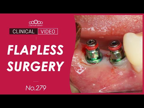 #45, 46 Implant placement with Flapless surgery [Dr. Cho Yongseok]