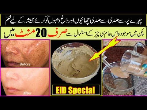 How To Get Rid of Hyper pigmentation - Freckles, Dark Spots, Melasma, Black Patches Fast Naturally