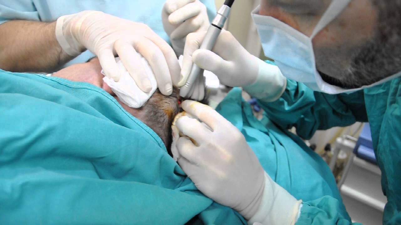 Ablatie cu laser CO2 tumoreta scalp, Dr. Jianu, ProEstetica YouTube