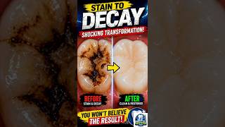 Stain to Decay – Surface stain turning into active cavity#viralreels#viral#video#viralshorts#views