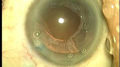 The Fladen Eye Center: Abridged Version of Capsular Tension Ring Insertion (CTR)