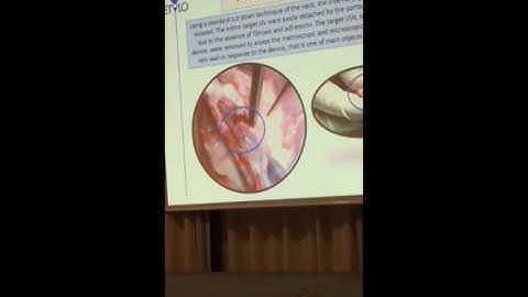 Huge development in CCSVI treatment - new stent model coming