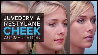 Cheek Augmentation With JUVEDERM® and Restylane® at Mabrie Facial Institute