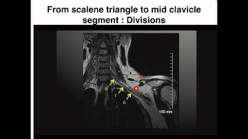 MRI Anatomy of Brachial Plexus