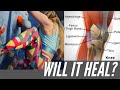 Let's Talk About Your Meniscus Tear...| Will It Heal?