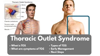 What is Thoracic Outlet Syndrome | Symptoms, Types of TOS, and Early Management