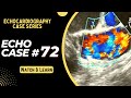 ECHO CASE 72 - Echocardiography for Beginners - Echo spot diagnosis Series - Cardiology