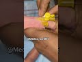 Iv cannula insertion in new born baby #patientcare #clinicalskills #doctor #hospitallife #medbed
