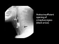 Swallowing disorders  aspiration due to stasis 2