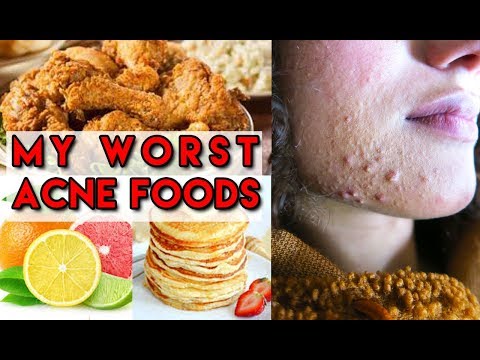  Worst Foods For Acne / Little Bumps | Acne causing foods