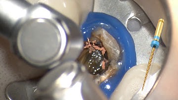 Remover, a nice tool to remove gutta-percha