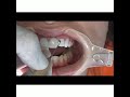 Direct Composite Veneers Smile Makeover Step by Step