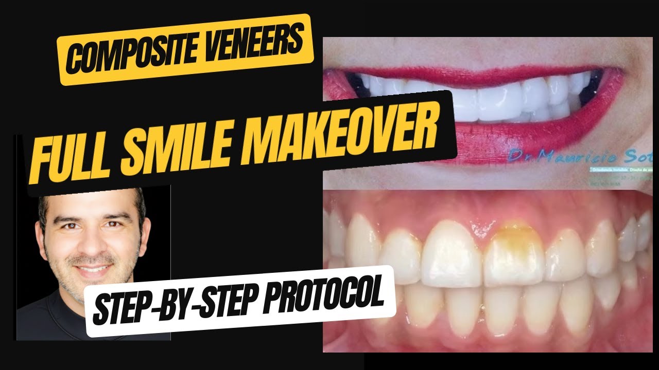 COMPOSITE VENEERS: Full Smile Makeover Step-by-Step Protocol