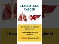 Stage 3 Lung Cancer: Navigating the Latest Data and Treatments