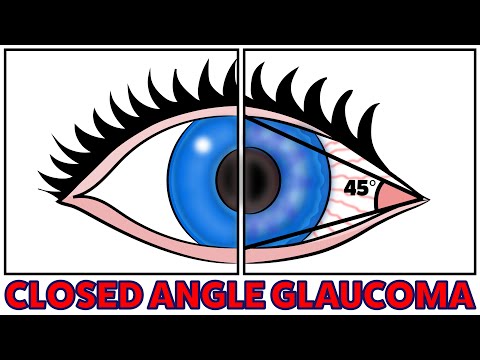 The simple 3 minute method to fix Closed Angle Glaucoma Naturally!