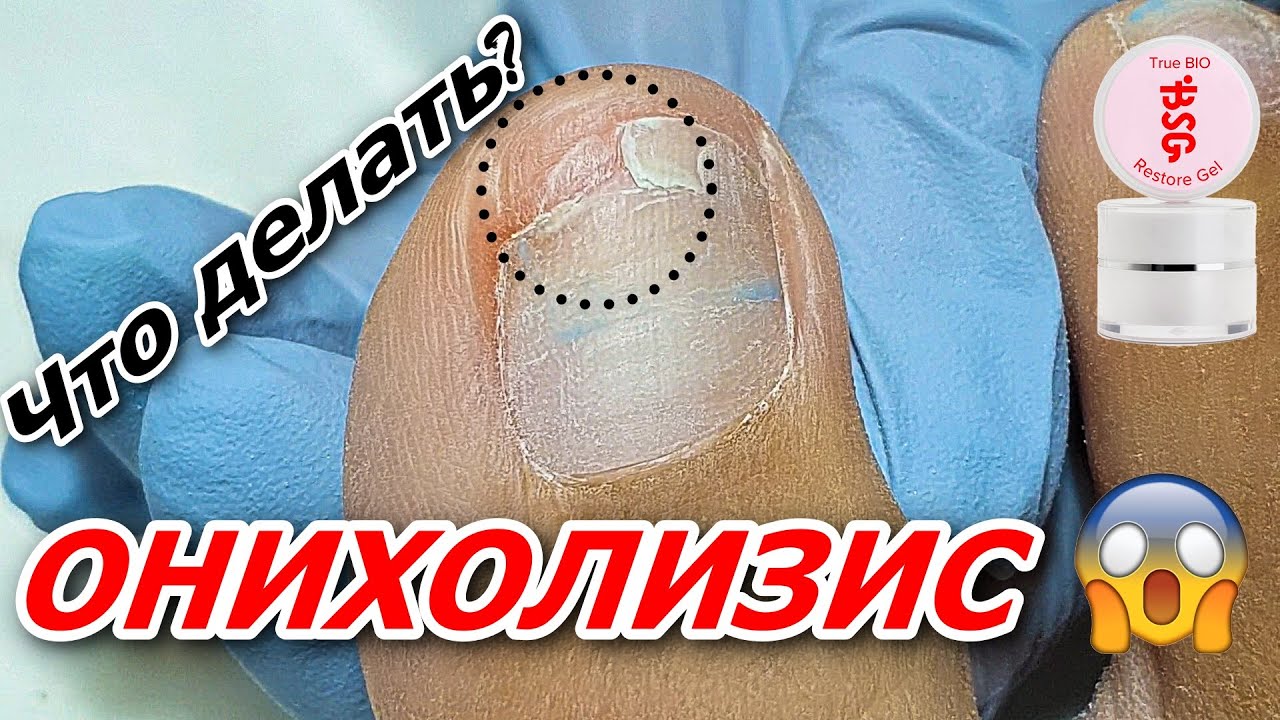 Онихолизис и как с ним работать 👣 - YouTube