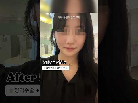 คลิปใหม่จากช่องทางการโรงพยาบาลอียู: 교정 후에도 남은 부정교합, 양악을 결심한 이유