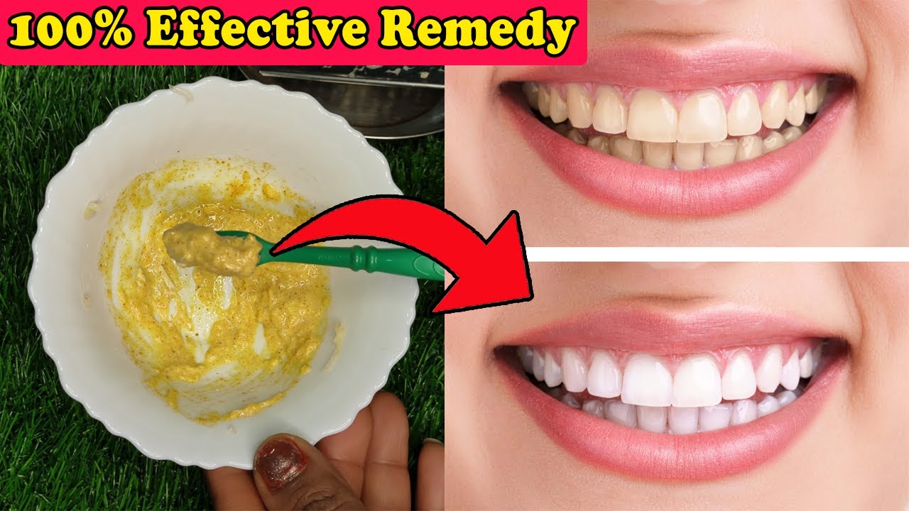 Whiten Yellow Teeth Naturally at Home in 5 Minutes Yellow Teeth