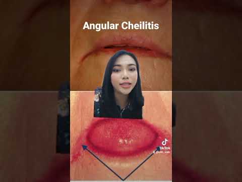 Video: Tidak boleh menghilangkan angular cheilitis?