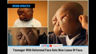TEENAGER WITH DEFORMED FACE GETS NEW LEASE OF FACE