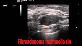 Mammella Sinistra Fibroadenoma
