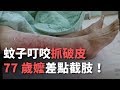 蚊子叮咬抓破皮 77歲嬤差點截肢 央廣新聞 蚊子叮咬抓破皮 77歲嬤差點截肢 央廣新聞