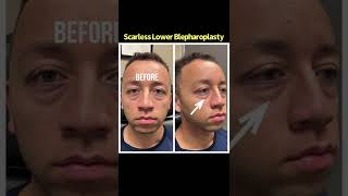 Young man undergoes Scarless Lower Blepharoplasty