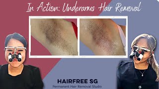 In Action: Underarms (Electrolysis Hair Removal)