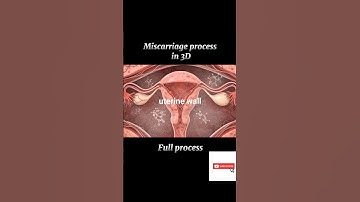 Miscarriage process in 3D #shortsfeed #miscarriages #complication