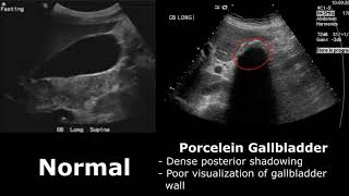 Gallbladder Ultrasound Normal Vs Abnormal Image Appearances Comparison | Gallbladder Pathologies