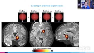 Connectomic DBS for OCD with Brian H. Kopell, MD