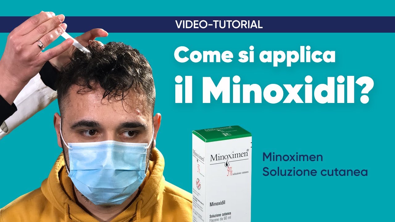 Minoxidil e caduta capelli: efficacia modalità di trattamento |