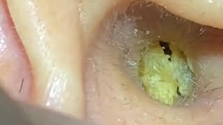 ASMR Ear Cleaning – The Creepiest Yet Most Satisfying Removal Ever!
