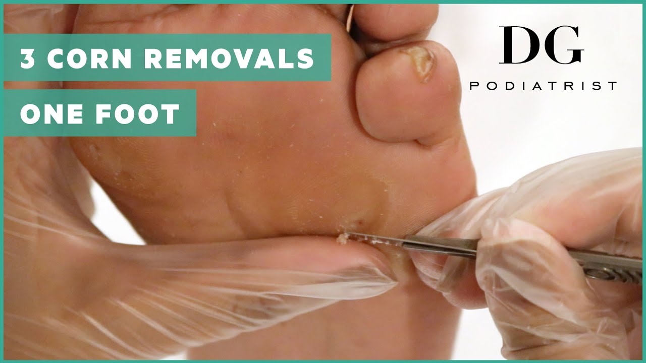 Foot Corn Removal — Bottom of Foot Callus Removal