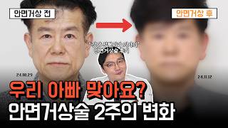 안면거상, 더 이상 낯설지 않다! 중년 남자의 변신 이야기ㅣ 안면거상 후 솔직한 후기