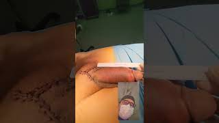 Penile enlargement surgery patient from Kuwait ?? European and American Urogical  Association member