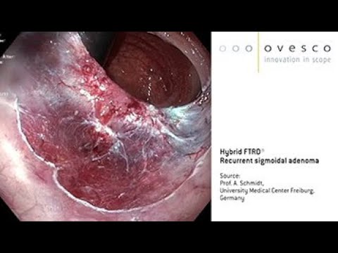 FTRD® System | Hybrid FTRD | Resection of recurrent sigmoidal adenoma