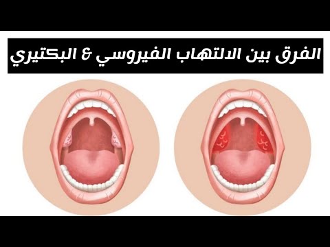 ايه الفرق بين التهاب اللوز الفيروسى و التهاب اللوز البكتيرى
