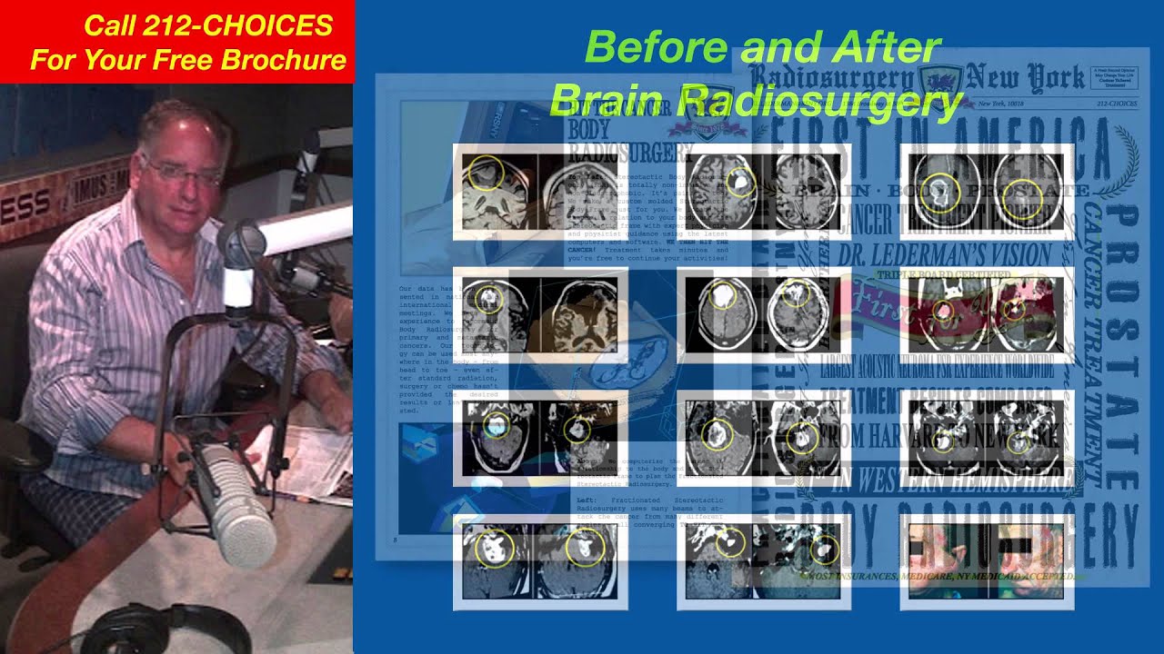 Dr. Gil Lederman's Radiosurgery Show! Podcast 113 Part ONE YouTube