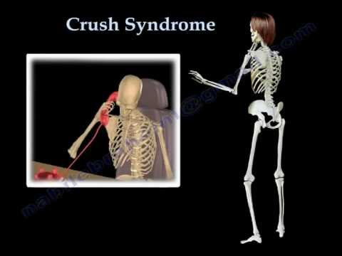 Crush Syndrome - Everything You Need To Know - Dr. Nabil Ebraheim