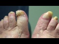 This patient takes her own video - long toenail cutting