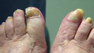 Can long toenails cause pain? This patient takes her own video - long toenail cutting