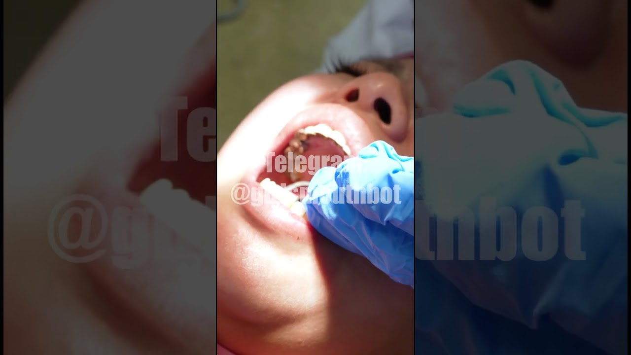 She has fillings in all her teeth. #dentist