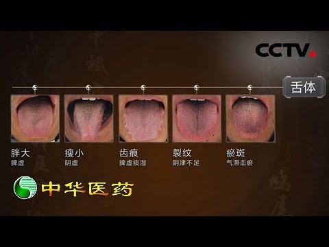 《中华医药》观舌知病：什么样的舌头才是最健康的呢？20190720 | CCTV中文国际