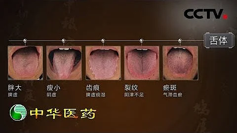 《中華醫藥》觀舌知病：什麼樣的舌頭才是最健康的？20190720 | CCTV中文國際 - 天天要聞