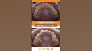 Hành trình LỘT XÁC nhờ niềng răng của Xuân Quỳnh  #braces #updental