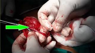 عملية دوالى الخصية    Testicular Varicocelectomy surgical operation فيديو 21 قناة د/ أيمن زغلول هزاع